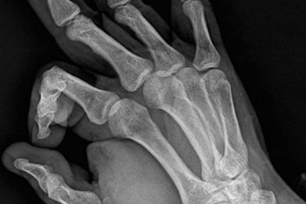 X Ray Results 6 X Ray Results 6